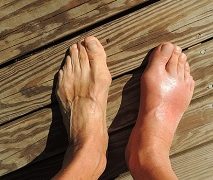 Natural Remedies For Gout – 6 Options You Can Try Today