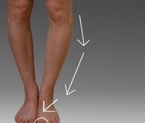 Natural Treatments For Bowed Legs