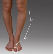 Treatments For Bowed Legs