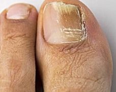 Nail Fungus: Causes, Treatment And Prevention